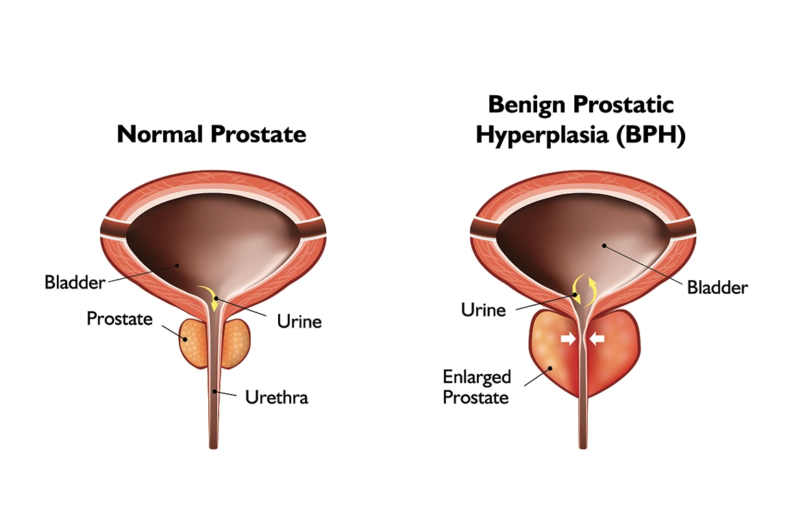 Normal Prostate vs BPH Prostate Illustration